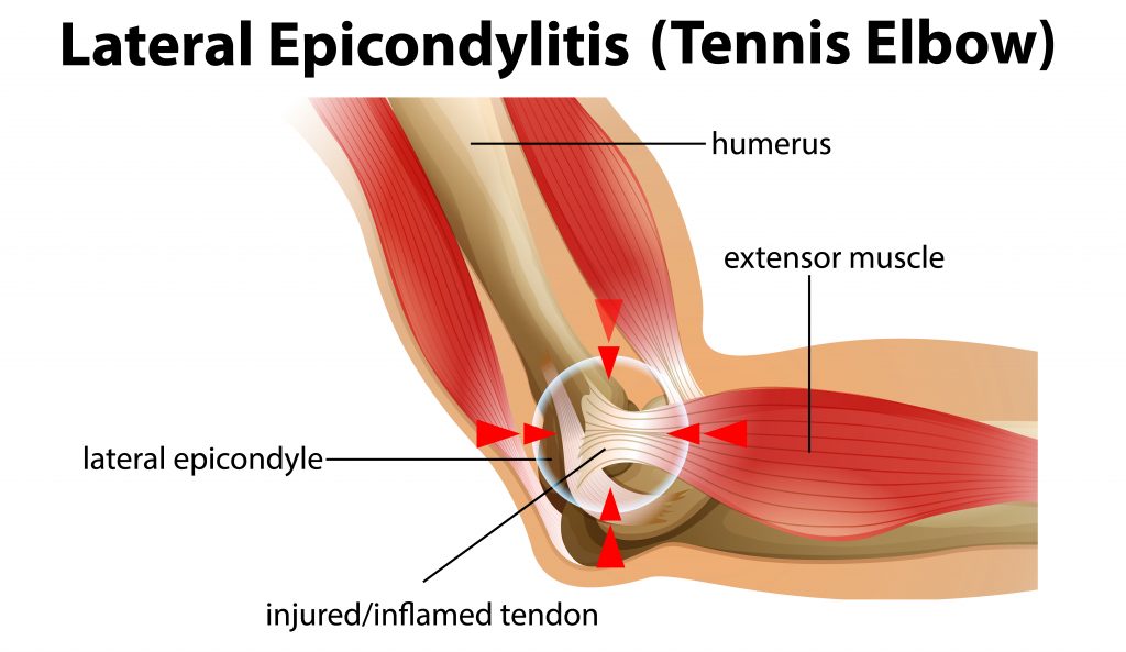 Tennis Elbow, Lateral Epicondylitis, อาการเจ็บข้อศอกของนักเทนนิส, ข้อศอกอักเสบ, Lateral Epicondylitis, ปวดข้อศอก